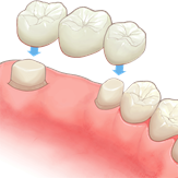 1つ目はブリッジ